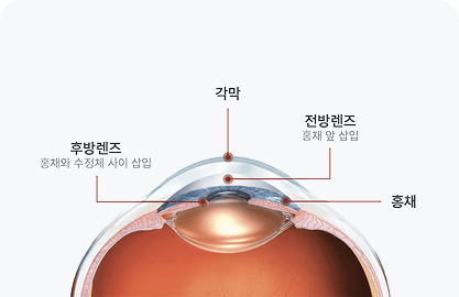 홍채 뒤 삽입 후방렌즈