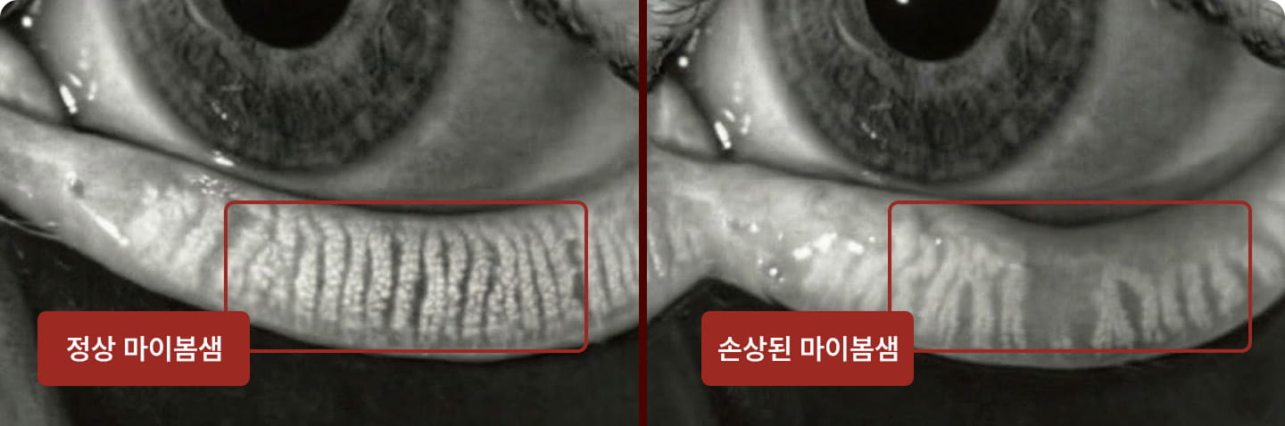 정상 마이봄샘과 손상된 마이봄샘 비교